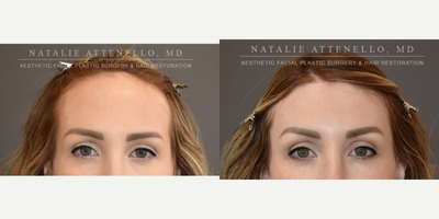 Brow Lift before and after photo