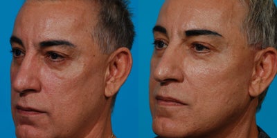 Facelift before and after photo