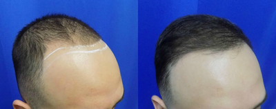 FUE Hair Transplant before and after photo