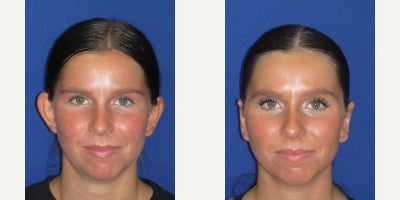 Ear Surgery before and after photo