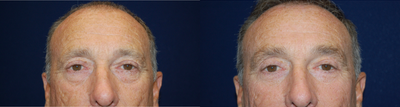 Eyelid Surgery before and after photo