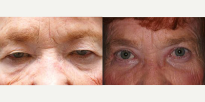 Eyelid Surgery before and after photo