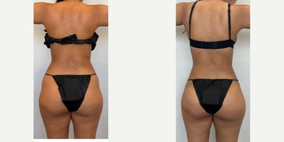 Liposuction before and after photo