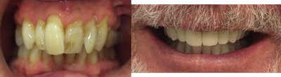 Porcelain Veneers before and after photo