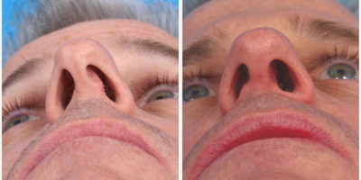 Septoplasty before and after photo
