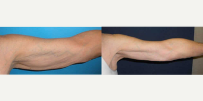 Arm Lift before and after photo