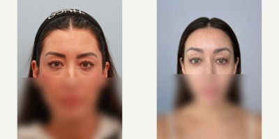 Cheek Lift before and after photo