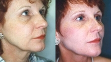 Facelift before and after photo