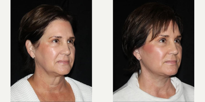 Facelift before and after photo