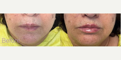 Lip Fillers before and after photo