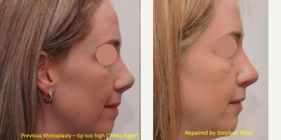 Revision Rhinoplasty before and after photo