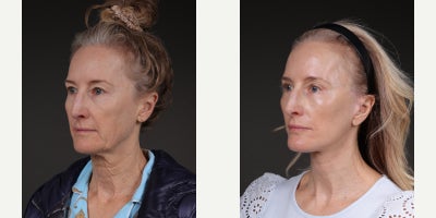 Facelift before and after photo