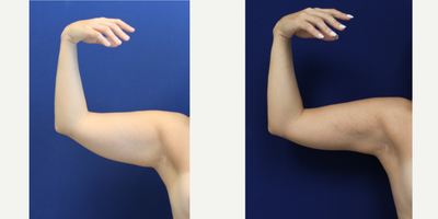 Liposuction before and after photo