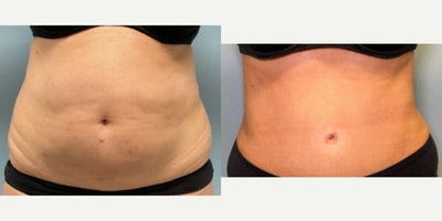 Liposuction before and after photo