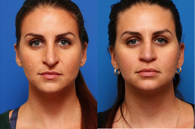 Revision Rhinoplasty before and after photo