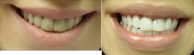 Zoom Whitening before and after photo