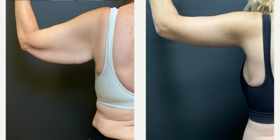 Arm Lift before and after photo
