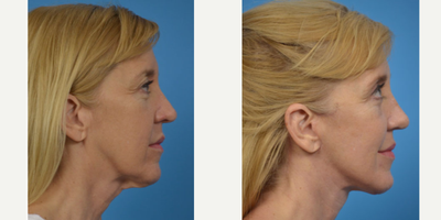 Facelift before and after photo