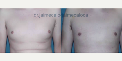 Feminizing Top Surgery before and after photo