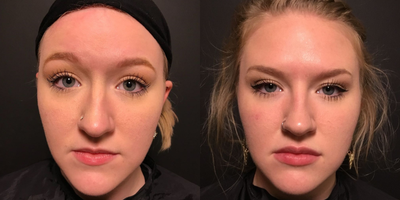 Lip Fillers before and after photo