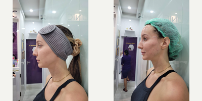 Restylane Defyne before and after photo