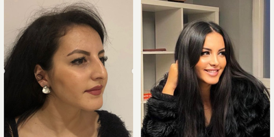 Rhinoplasty before and after photo