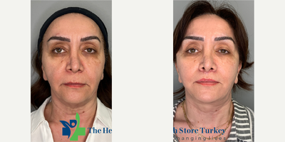 Deep Plane Facelift before and after photo