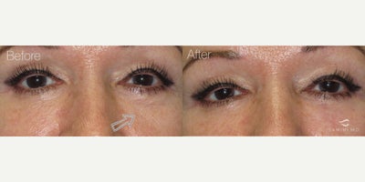 Dermal Fillers before and after photo