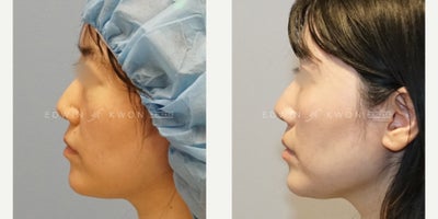 Eyelid Surgery before and after photo