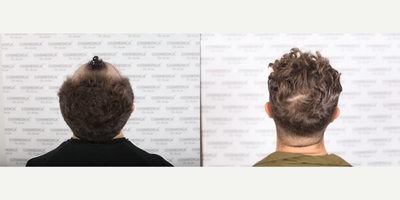 FUE Hair Transplant before and after photo