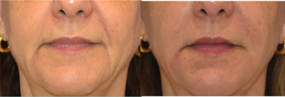 Juvederm before and after photo