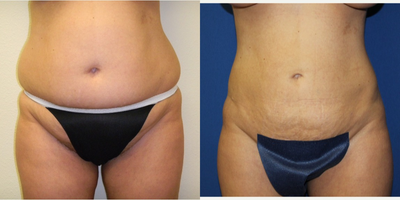 Vaser Liposuction before and after photo