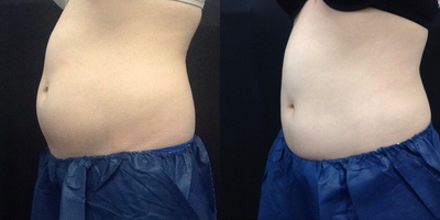 CoolSculpting before and after photo