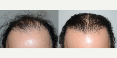 FUE Hair Transplant before and after photo