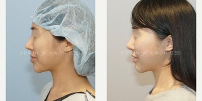 before and after image