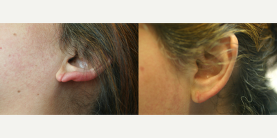 Earlobe Repair before and after photo