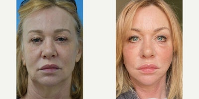 Facelift before and after photo
