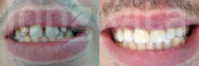 Porcelain Veneers before and after photo