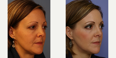 CO2 Laser before and after photo