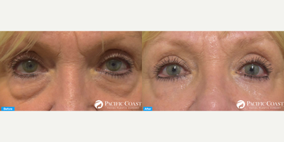 Eyelid Surgery before and after photo