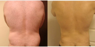 Liposuction before and after photo