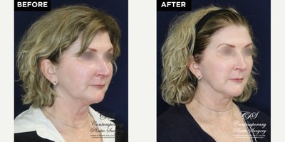 before and after image