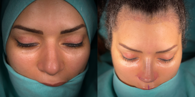 Rhinoplasty before and after photo