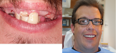 Smile Makeover before and after photo