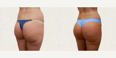 Butt Augmentation before and after photo