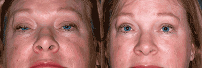 Eyelid Surgery before and after photo