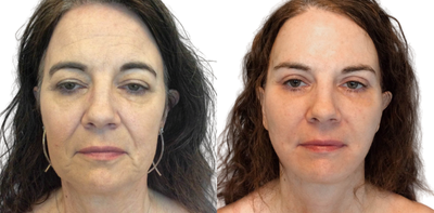 Facelift before and after photo
