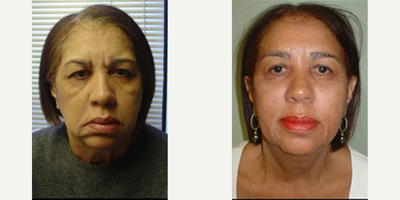 Nonsurgical Facelift before and after photo
