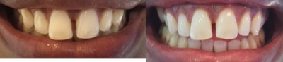Teeth Whitening before and after photo