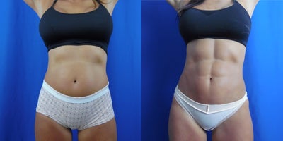 Abdominal Etching before and after photo